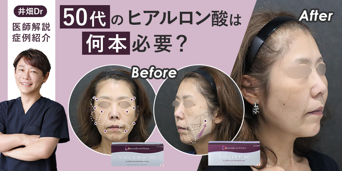 【症例解説】50代のヒアルロン酸は何本必要?