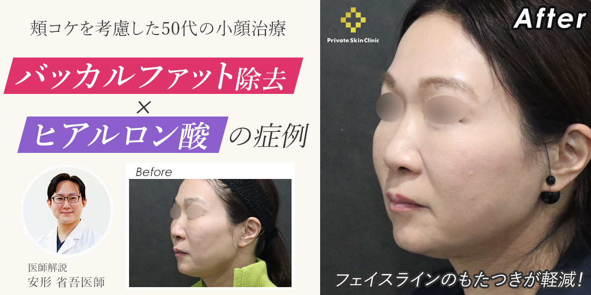 バッカルファット除去×ヒアルロン酸の症例|頬コケを考慮した50代の小顔治療