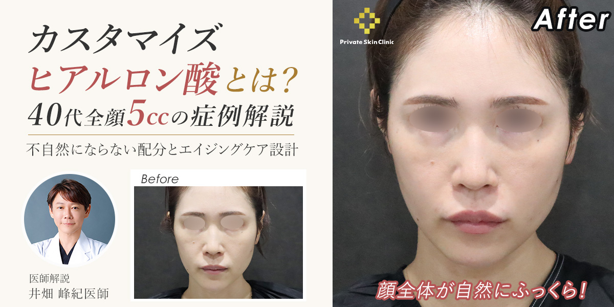 カスタマイズヒアルロン酸とは?40代全顔5ccの症例解説|不自然にならない配分とエイジングケア設計