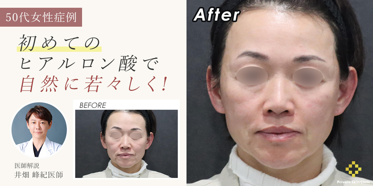 初めてのヒアルロン酸で自然に若々しく|50代女性の症例をご紹介