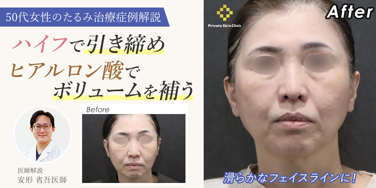 ハイフで引き締め、ヒアルロン酸でボリュームを補う|50代のたるみ治療症例