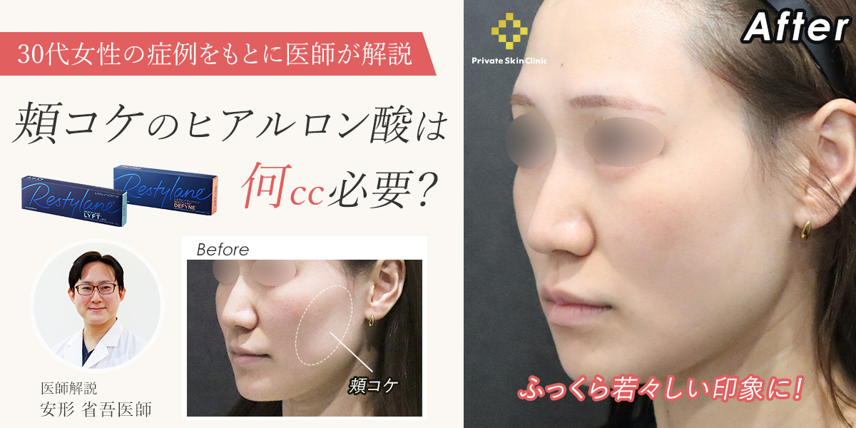 頬コケのヒアルロン酸は何cc必要?症例をもとに医師が解説