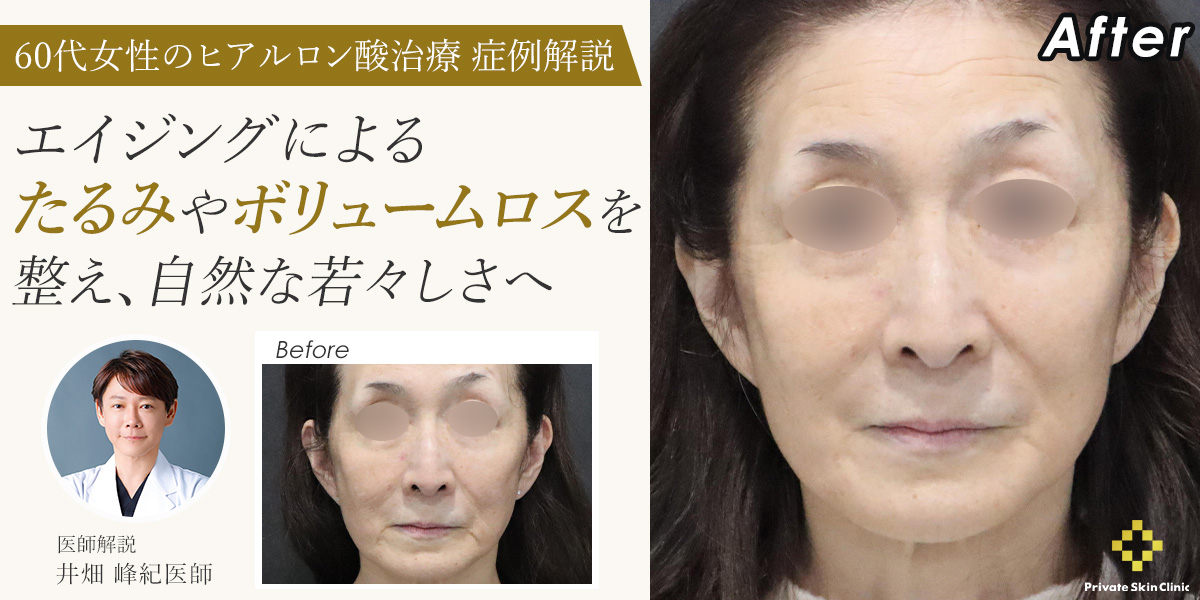 【症例解説】60代女性のヒアルロン酸治療|エイジングによるたるみやボリュームロスを整え、自然な若々しさへ