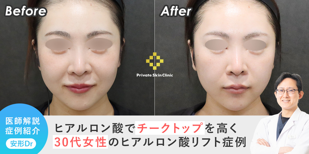 ヒアルロン酸でチークトップを高く。30代女性のヒアルロン酸リフト症例