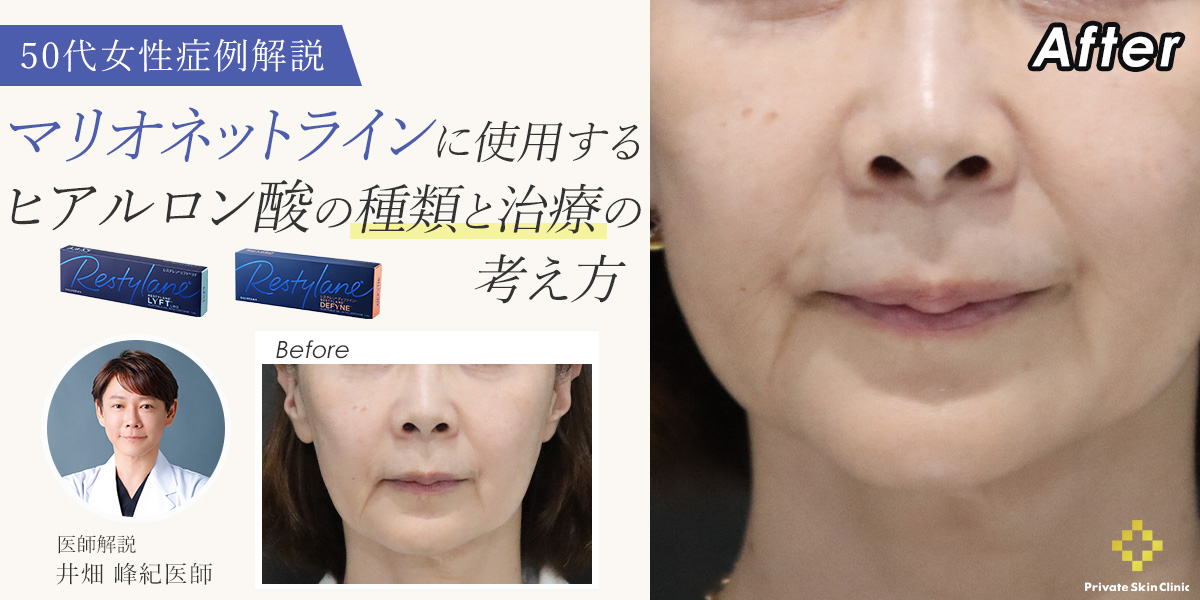 【症例解説】マリオネットラインに使用するヒアルロン酸の種類と治療の考え方