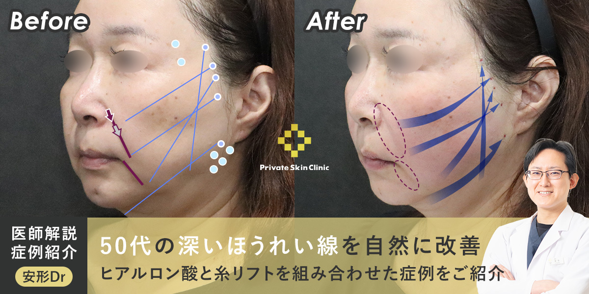 50代の深いほうれい線を自然に改善|ヒアルロン酸と糸リフトを組み合わせた症例をご紹介
