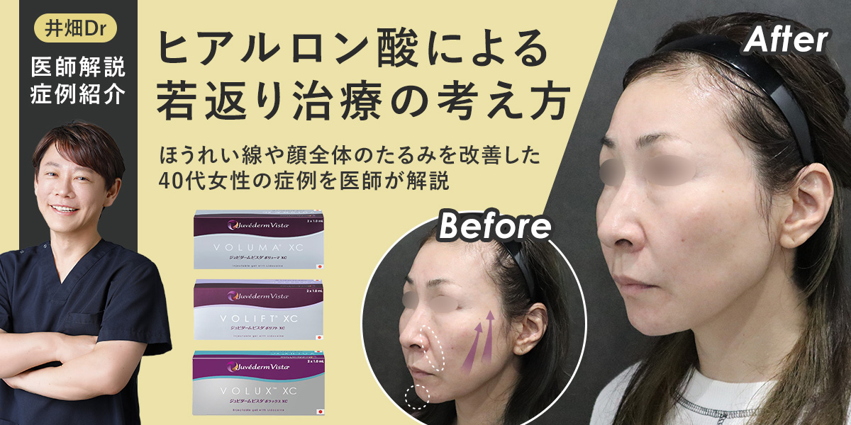 ヒアルロン酸による若返り治療の考え方|ほうれい線や顔全体のたるみを改善した40代女性の症例を医師が解説
