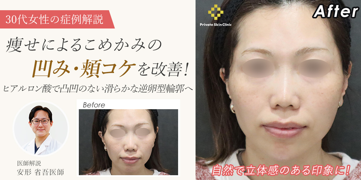 【症例解説】痩せによるこめかみの凹み・頬コケを改善|ヒアルロン酸で凸凹のない滑らかな逆卵型輪郭へ